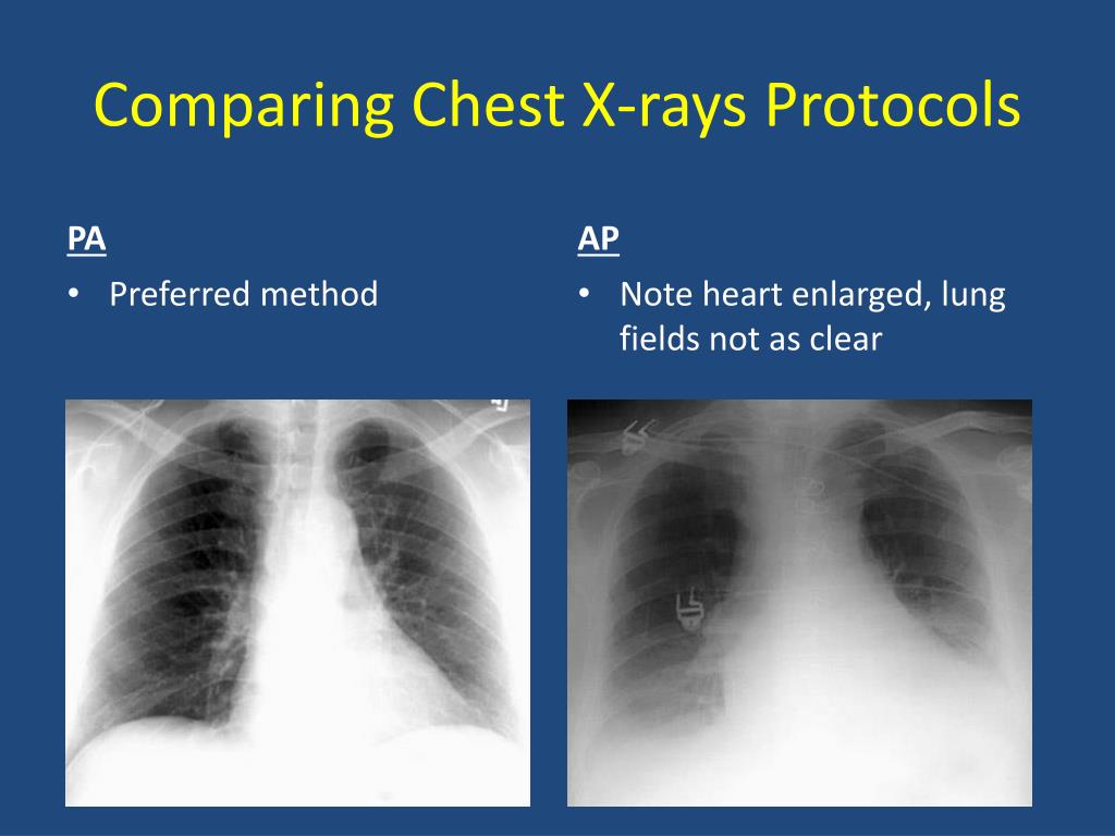PPT Basics of Chest XRay PowerPoint Presentation, free download ID