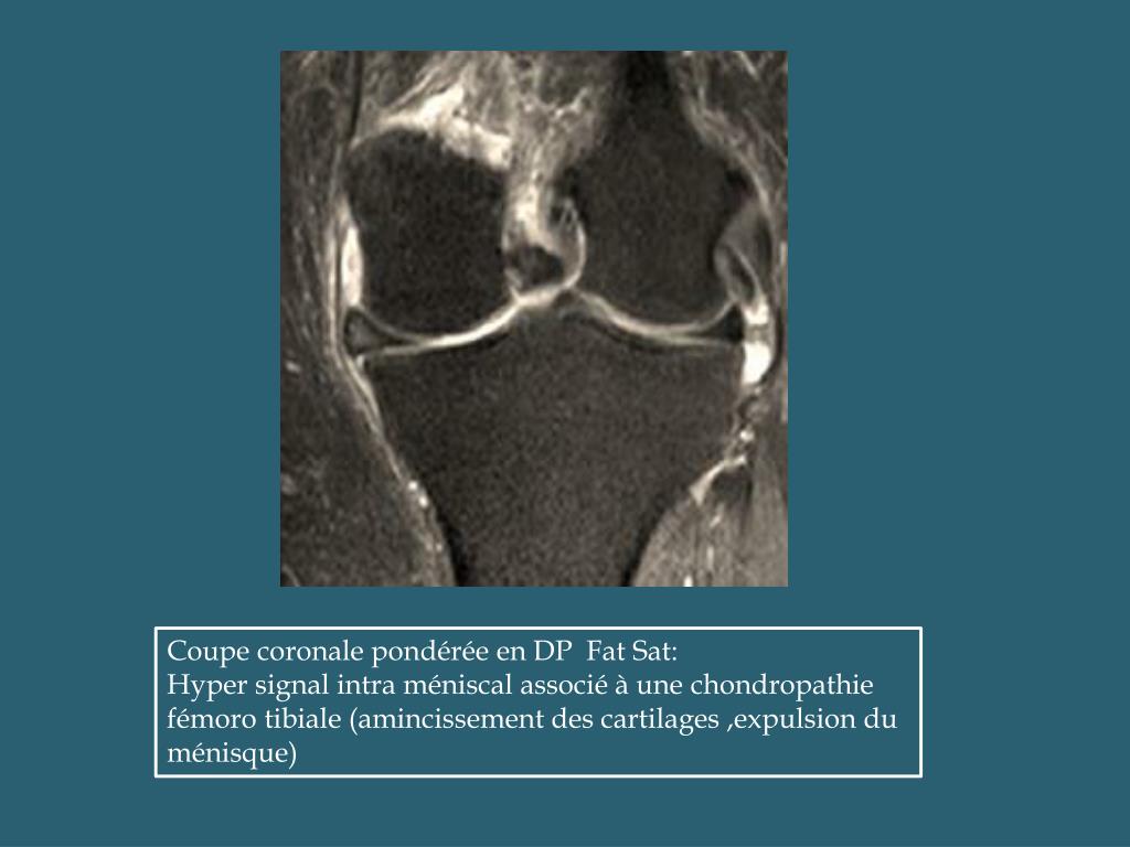 PPT ATLAS IRM DES LESIONS MENISCO LIGAMENTAIRES DU GENOU PowerPoint