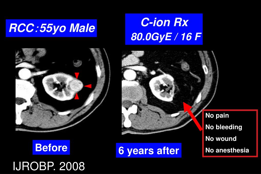 PPT CARBON ION THERAPY FOR SACRAL CHORDOMAS PowerPoint Presentation
