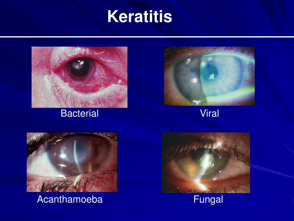 PPT The Red Eye and Selected Ocular Emergencies PowerPoint