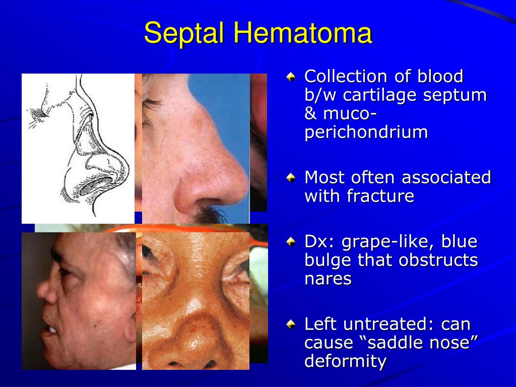 PPT Maxillofacial Injuries in Sports and Exercise PowerPoint