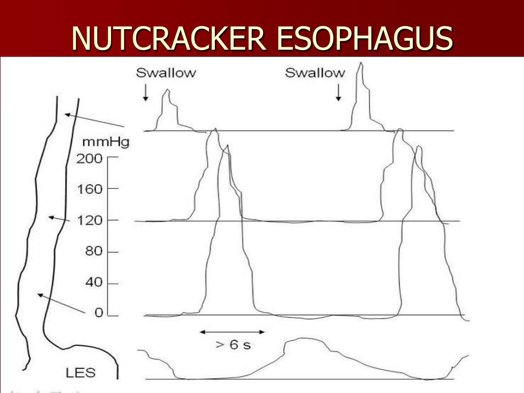 PPT ESOPHAGEAL TOPICS PowerPoint Presentation, free download ID5641383