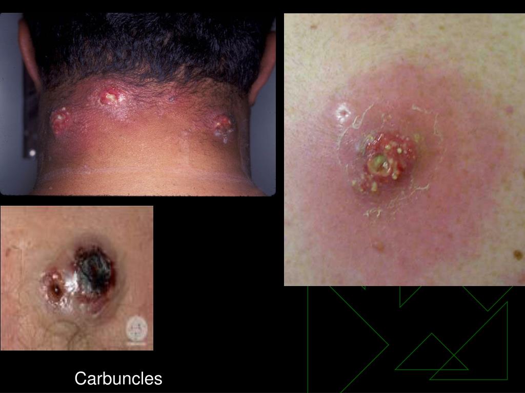 PPT Bacterial Skin Infections PowerPoint Presentation, free download
