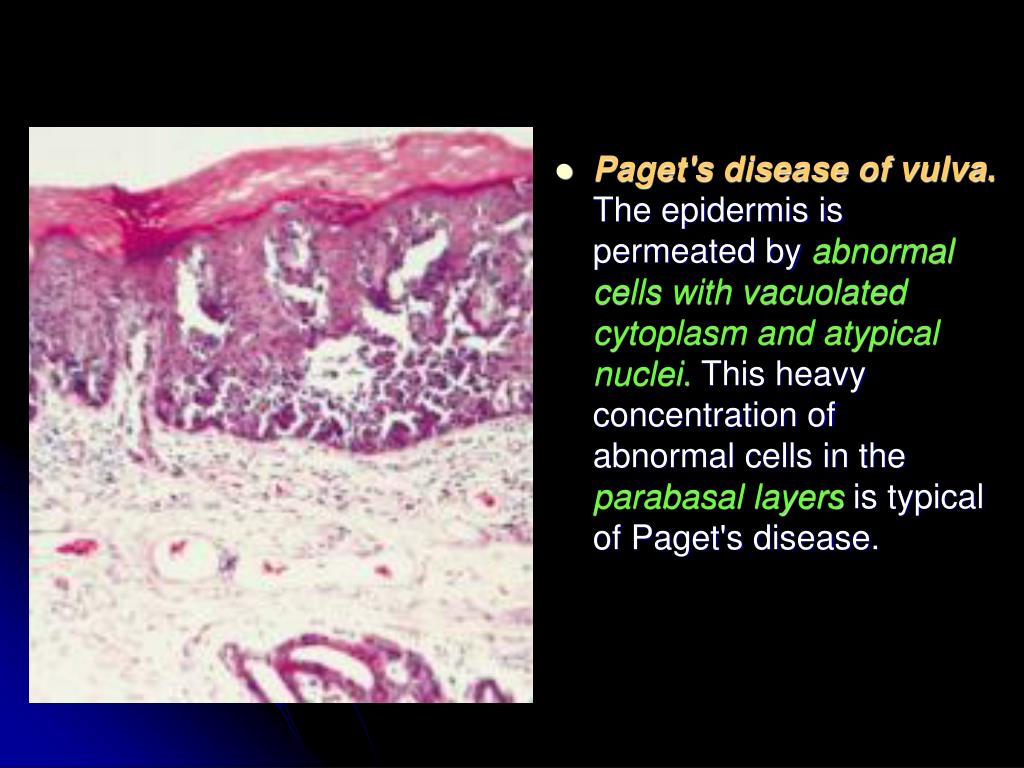 How Rare Is Paget's Disease Of The Vulva at Rita Reed blog