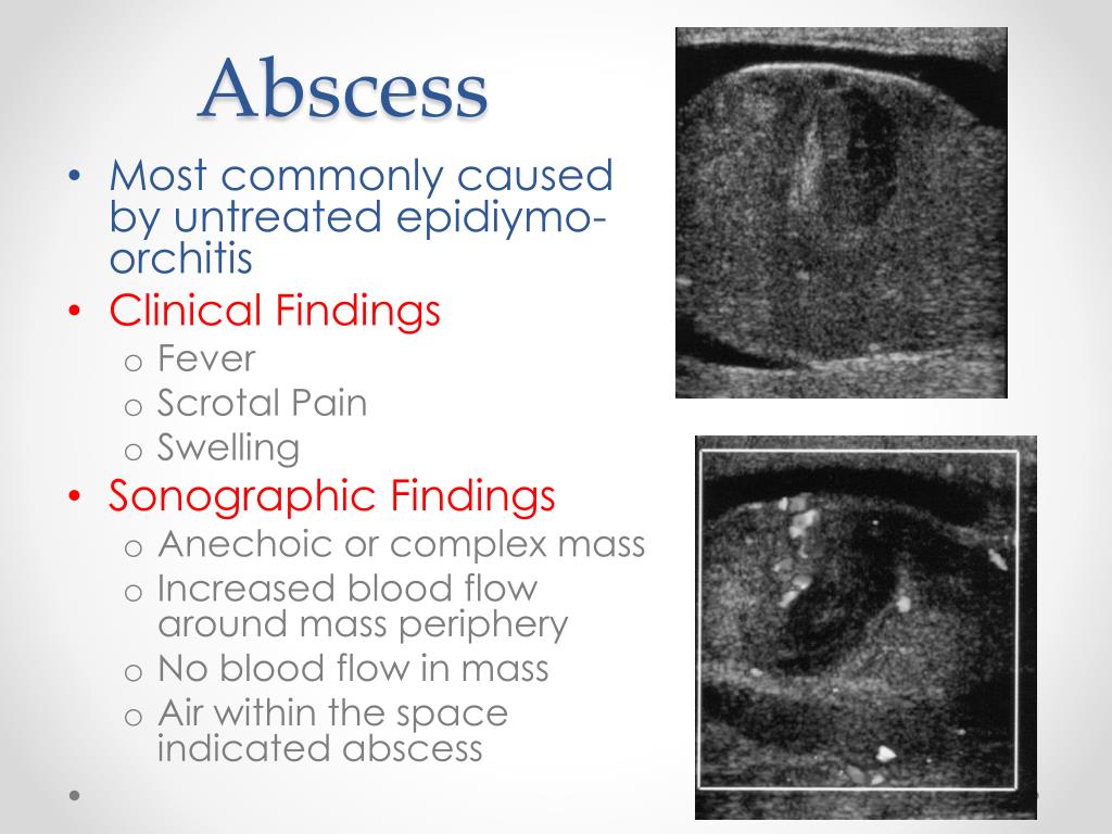 Epididymal Abscess Ultrasound