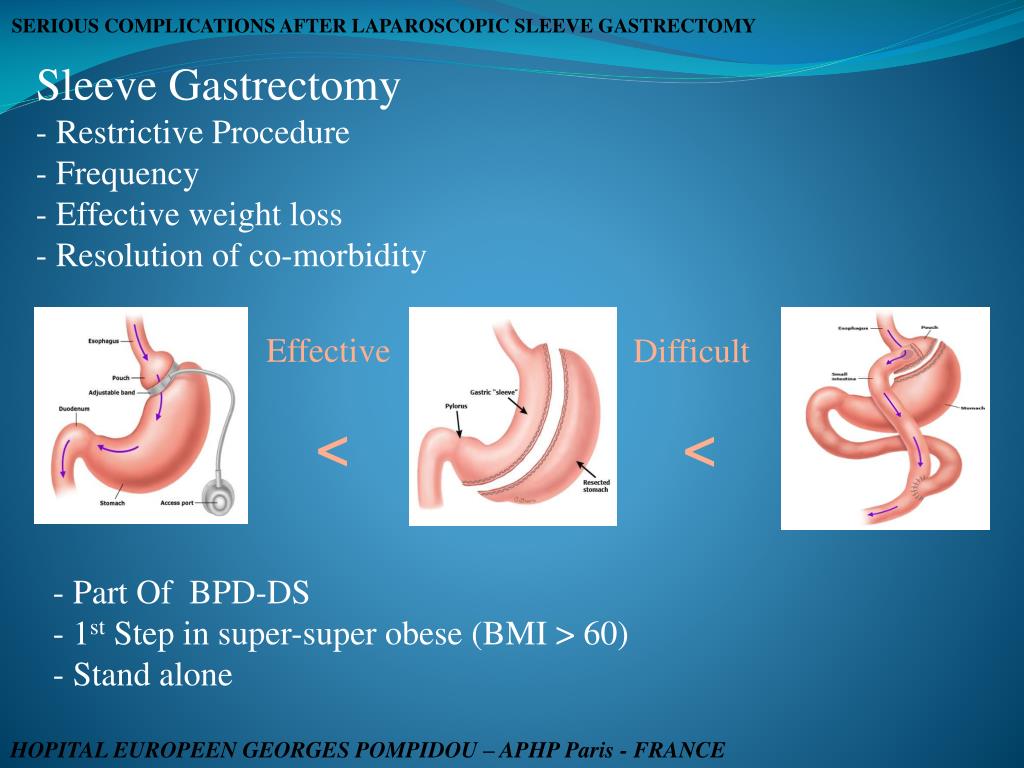 PPT SERIOUS COMPLICATIONS AFTER LAPAROSCOPIC SLEEVE GASTRECTOMY THE