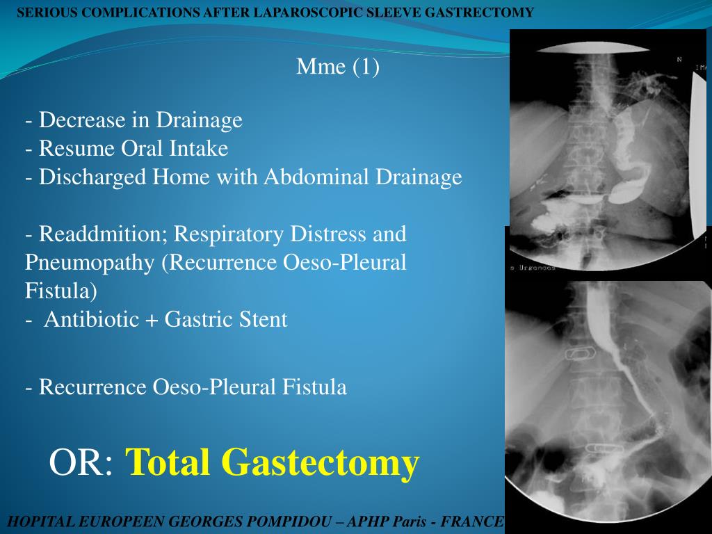 PPT SERIOUS COMPLICATIONS AFTER LAPAROSCOPIC SLEEVE GASTRECTOMY THE