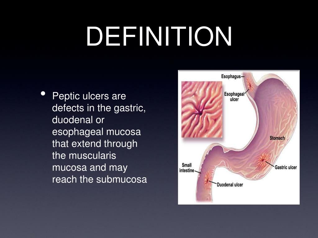 PPT PEPTIC ULCER DISEASE PowerPoint Presentation, free download ID
