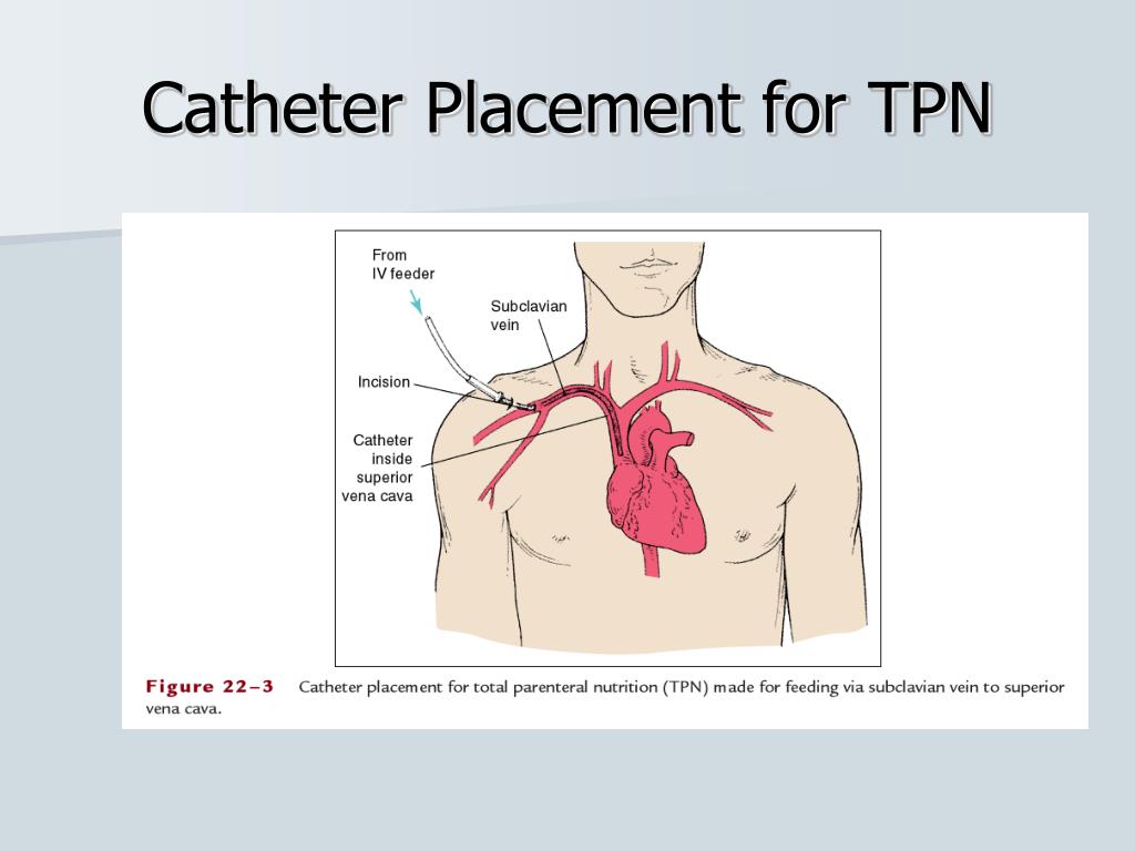 PPT Surgery and Nutritional Support PowerPoint Presentation, free