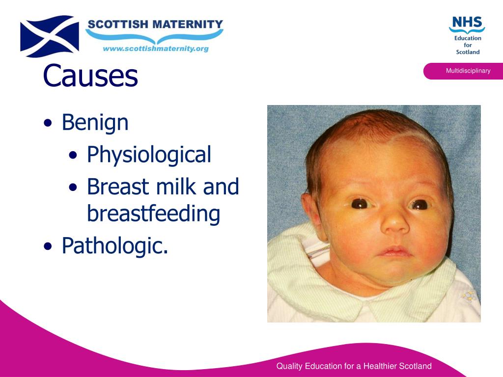 PPT Neonatal Jaundice PowerPoint Presentation, free download ID5708317