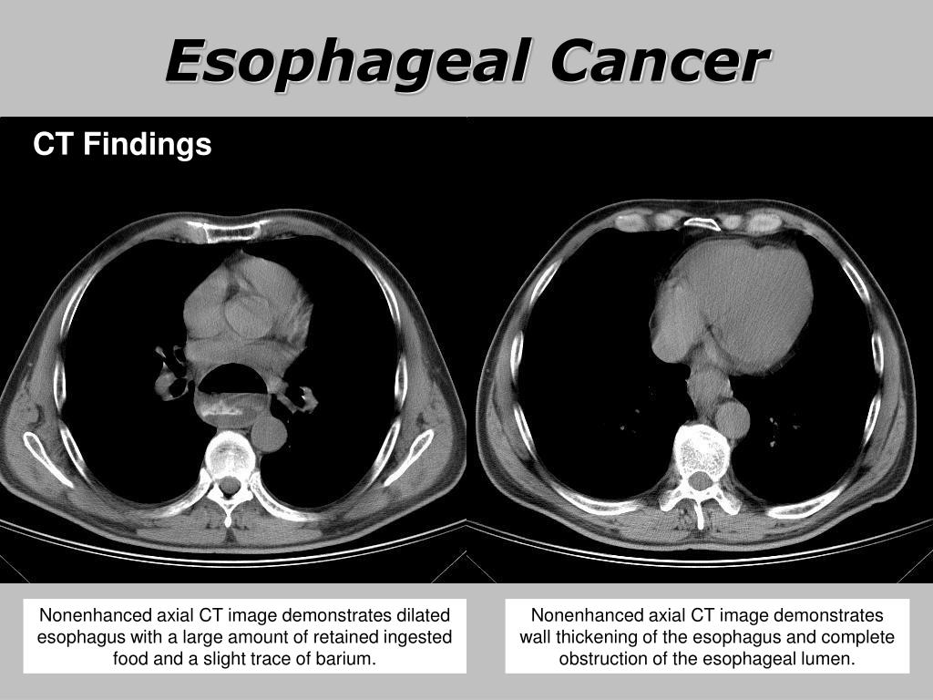 PPT Esophageal Cancer PowerPoint Presentation, free download ID5735568