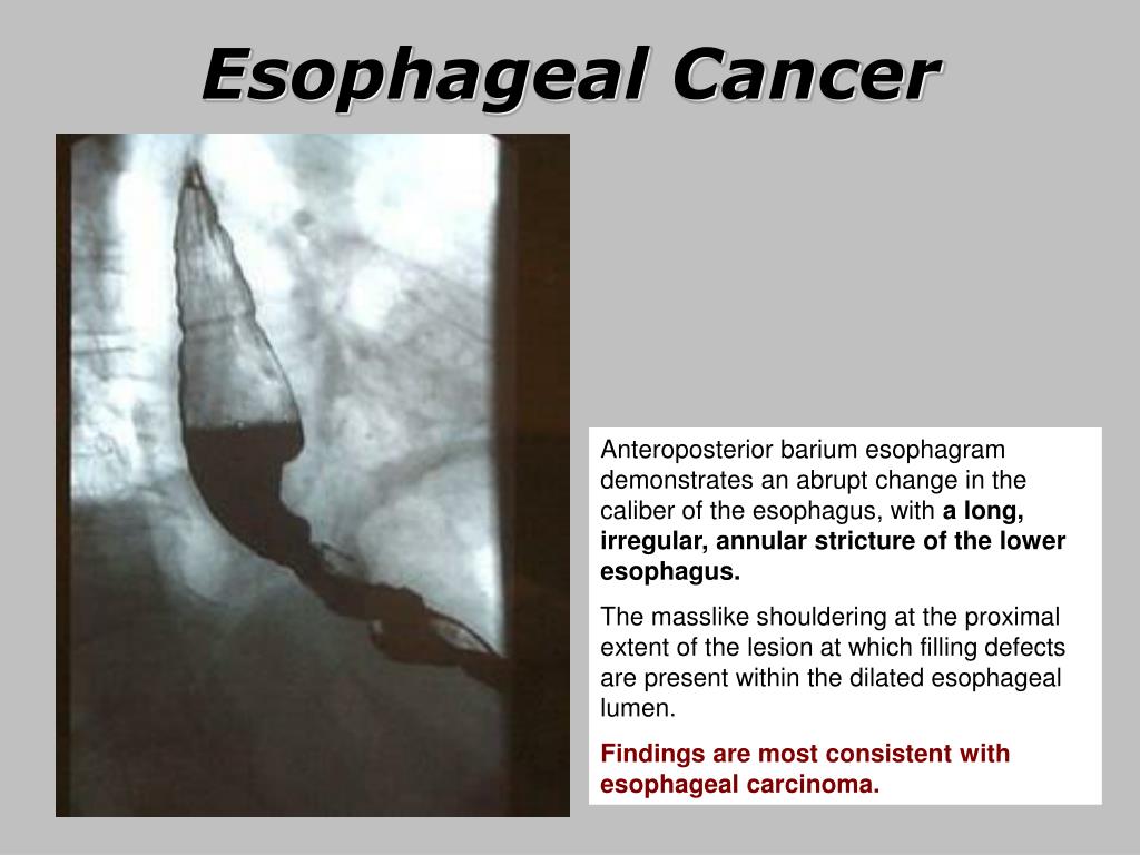 PPT Esophageal Cancer PowerPoint Presentation, free download ID5735568