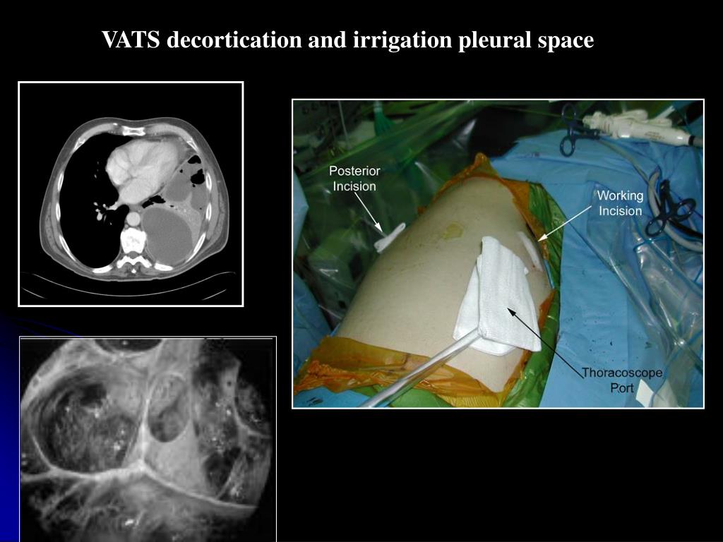 PPT PLEURAL EMPYEMA PowerPoint Presentation, free download ID5735694