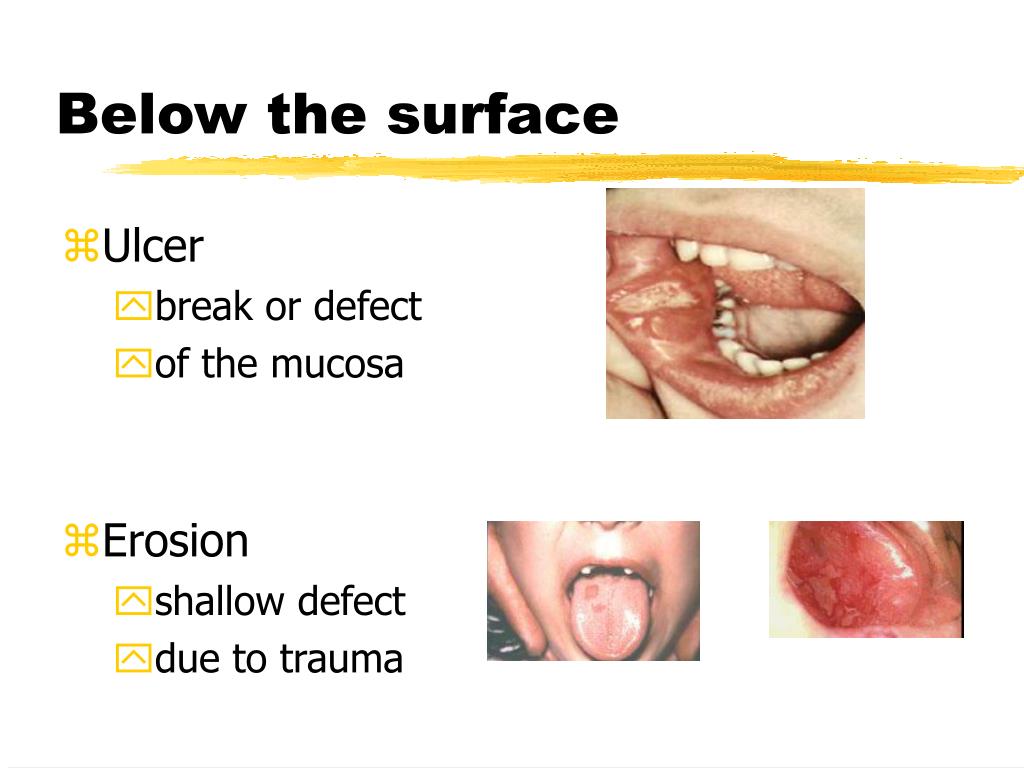 PPT ORAL PATHOLOGY PowerPoint Presentation, free download ID5755148