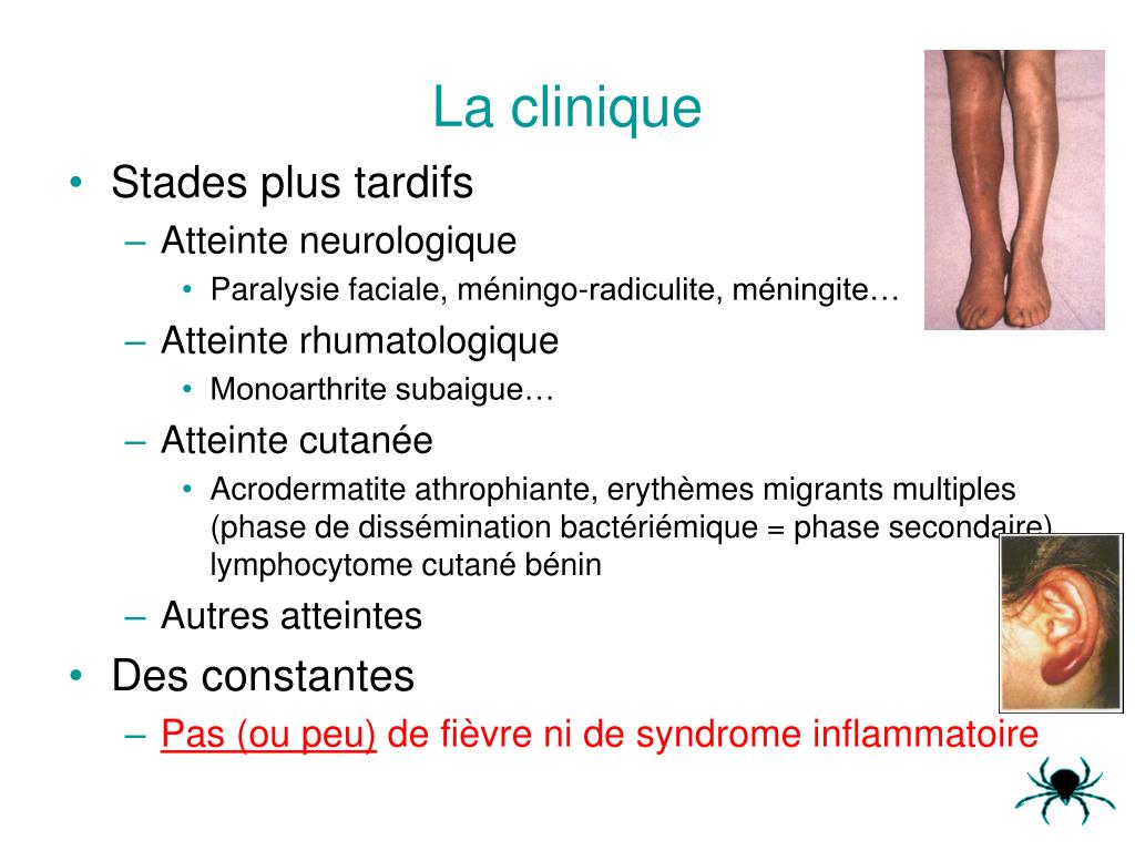 Maladie de Lyme symptômes et diagnostic pour les 3 phases de Ly…