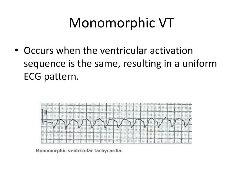 PPT Ventriclar Tachycardia PowerPoint Presentation, free download