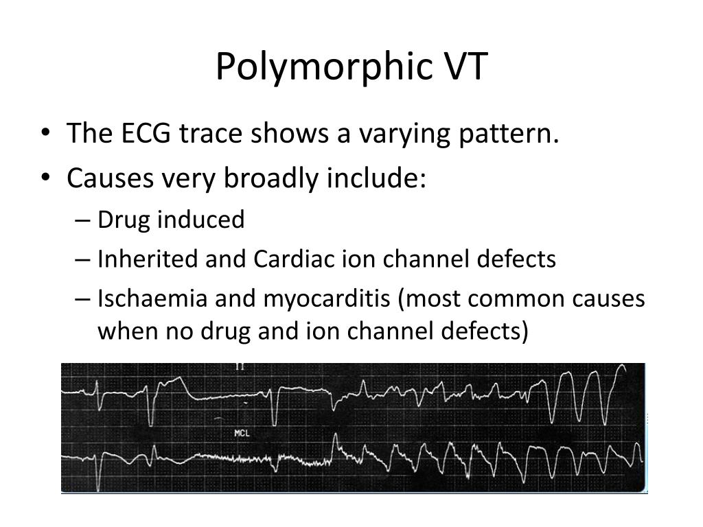 PPT Ventriclar Tachycardia PowerPoint Presentation, free download