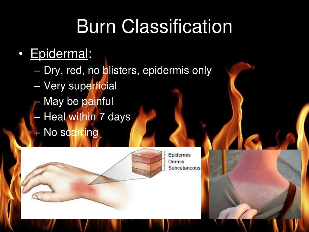 PPT Burn Management PowerPoint Presentation, free download ID5910760