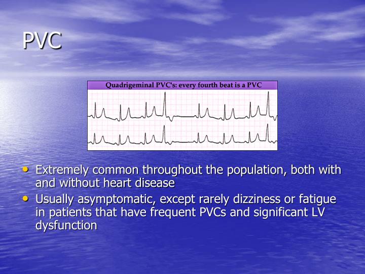 PPT Cardiac Arrhythmias An Update PowerPoint Presentation ID5925812