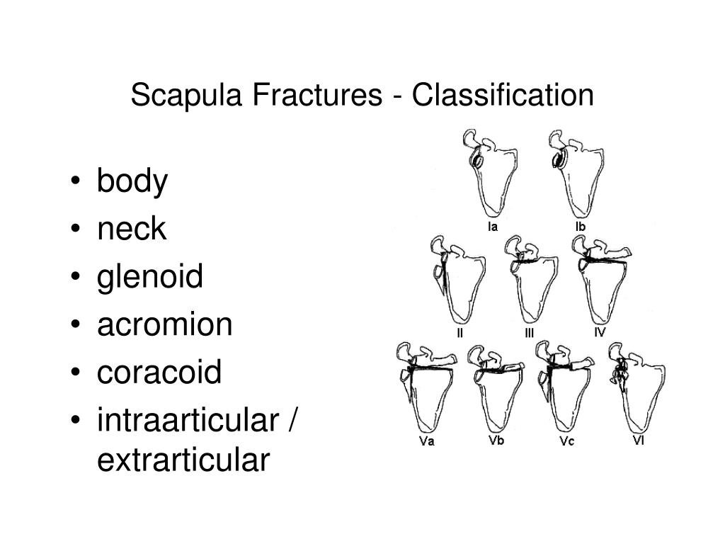 PPT Proximal Humeral Fracture in Children PowerPoint Presentation