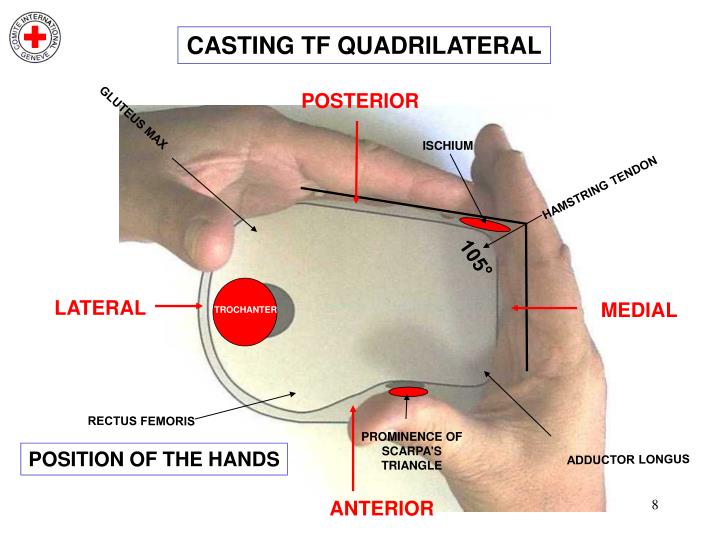 PPT MEASUREMENTS, CASTING & RECTIFICATION FOR TRANSFEMORAL (TF