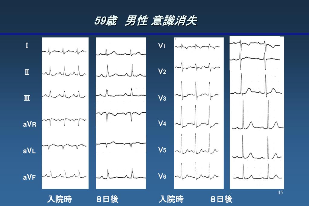 PPT 急性冠症候群 専門医へ送るタイミング PowerPoint Presentation ID