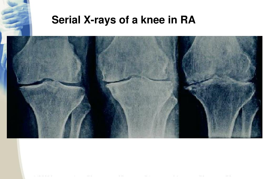 PPT RHEUMATOID ARTHRITIS (RA) PowerPoint Presentation, free download