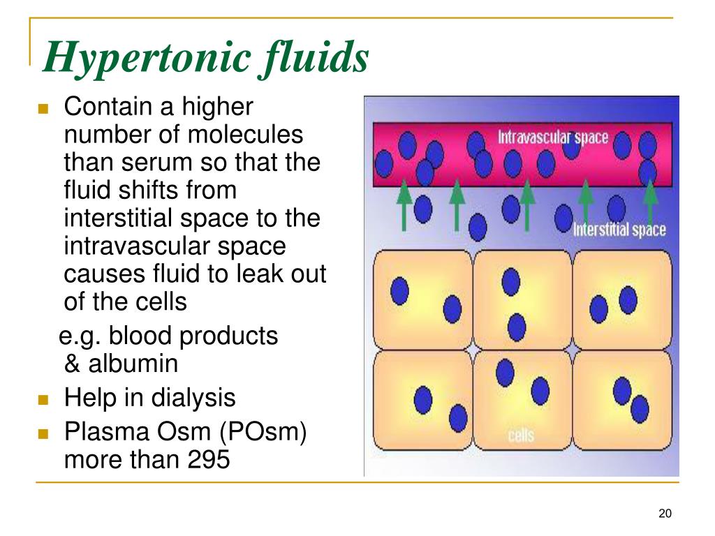 Hypertonic Solution Iv Fluids Headline News