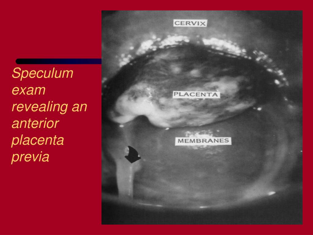 PPT Bleeding Late in Pregnancy PowerPoint Presentation, free download