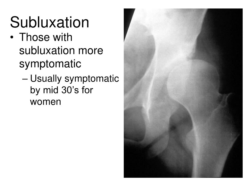 PPT Pediatric Hip PowerPoint Presentation, free download ID6051313