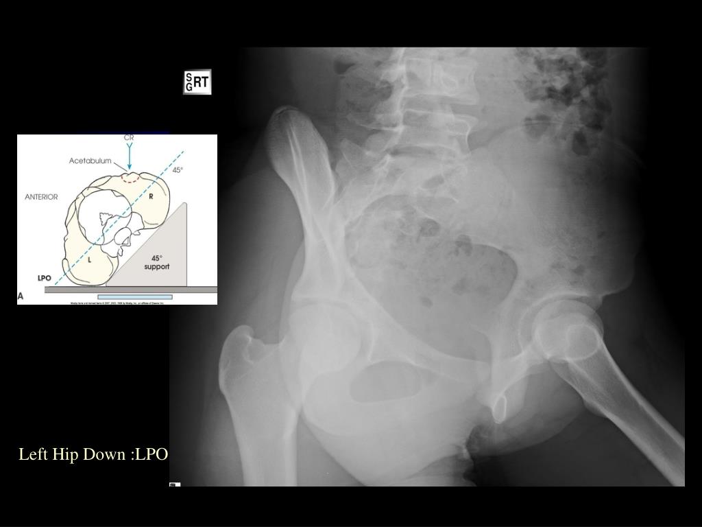 PPT Pelvic Girdle PowerPoint Presentation, free download ID6062924