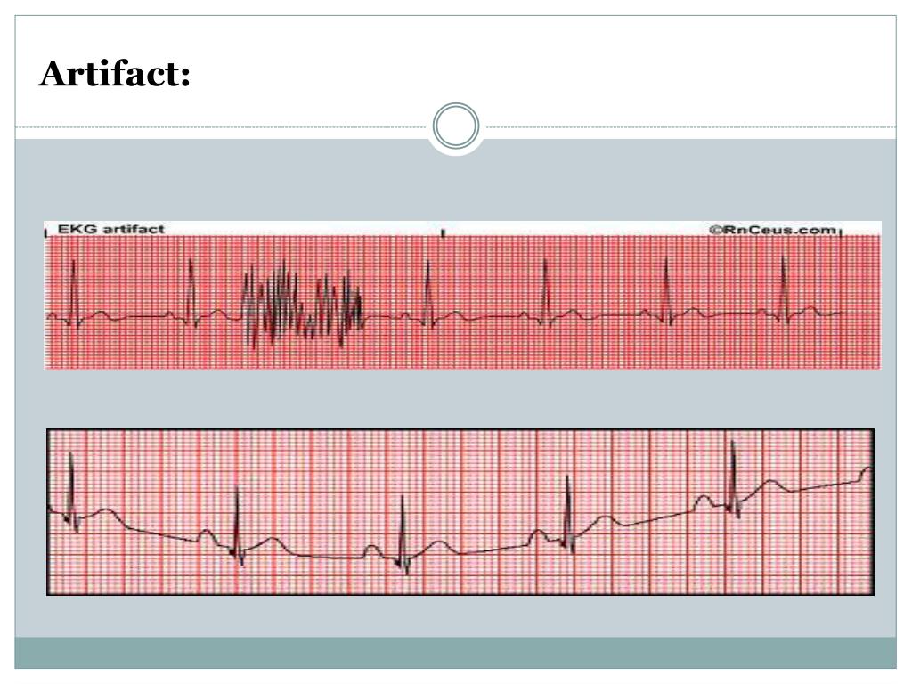 PPT Cardiovascular Monitoring Cardiac Dysrhythmia PowerPoint