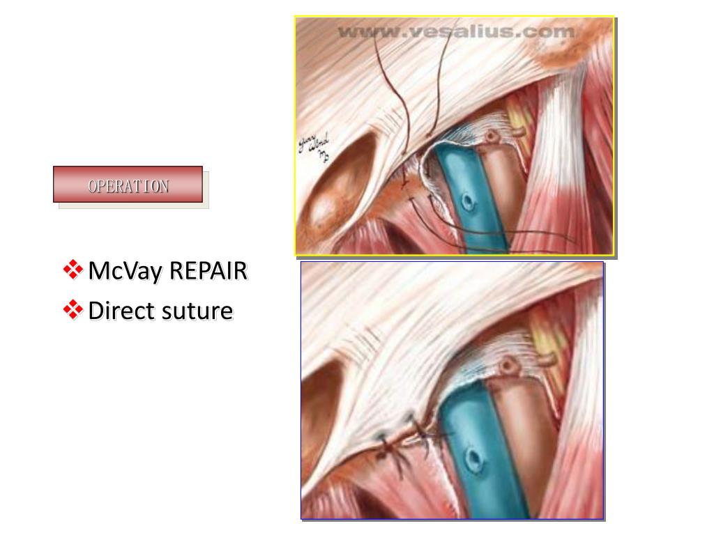 PPT Hernias, and Intraperitoneal abscess PowerPoint Presentation