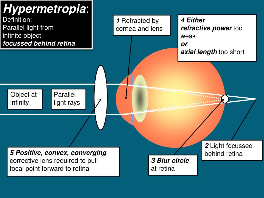 PPT Retinoscopy PowerPoint Presentation, free download ID6119694