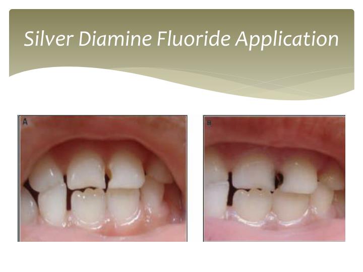 PPT Silver Diamine Fluoride PowerPoint Presentation ID6138027