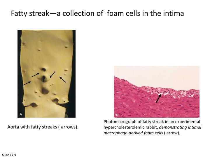 PPT ATHEROSCLEROSIS PowerPoint Presentation ID6143496