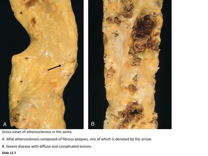 PPT ATHEROSCLEROSIS PowerPoint Presentation ID6143496