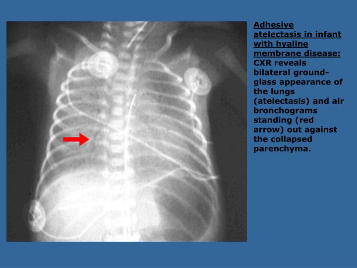 PPT Atelectasis PowerPoint Presentation ID6185976