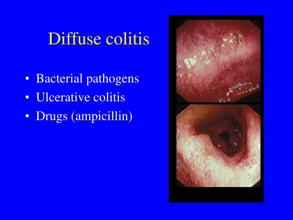 PPT Diarrhea . . . . A Messy Subject PowerPoint