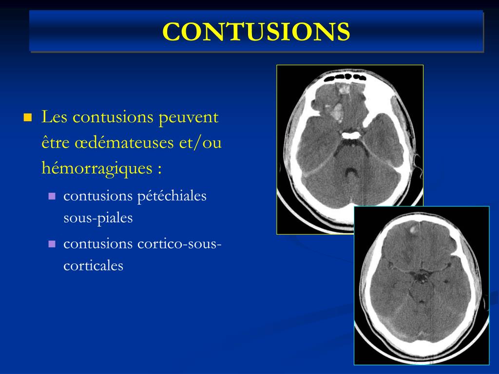 PPT TRAUMATISMES CRÂNIOENCEPHALIQUES PowerPoint Presentation, free