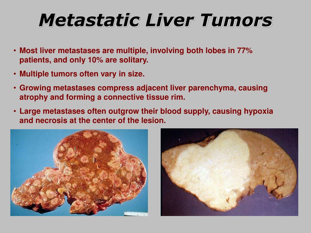 PPT Liver Cancer PowerPoint Presentation, free download ID6399378