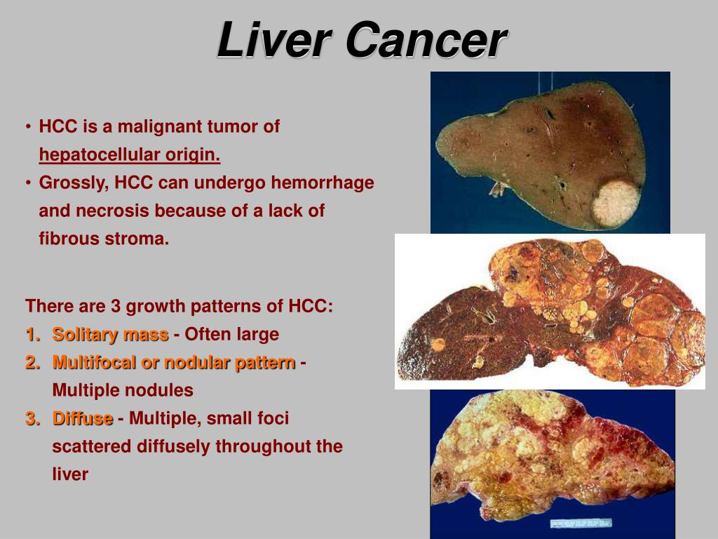 PPT Liver Cancer PowerPoint Presentation, free download ID6399378