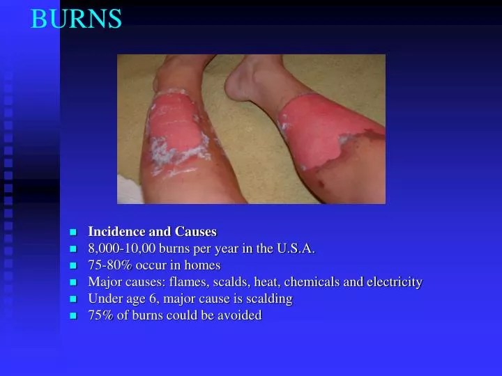 PPT BURNS PowerPoint Presentation, free download ID6405329