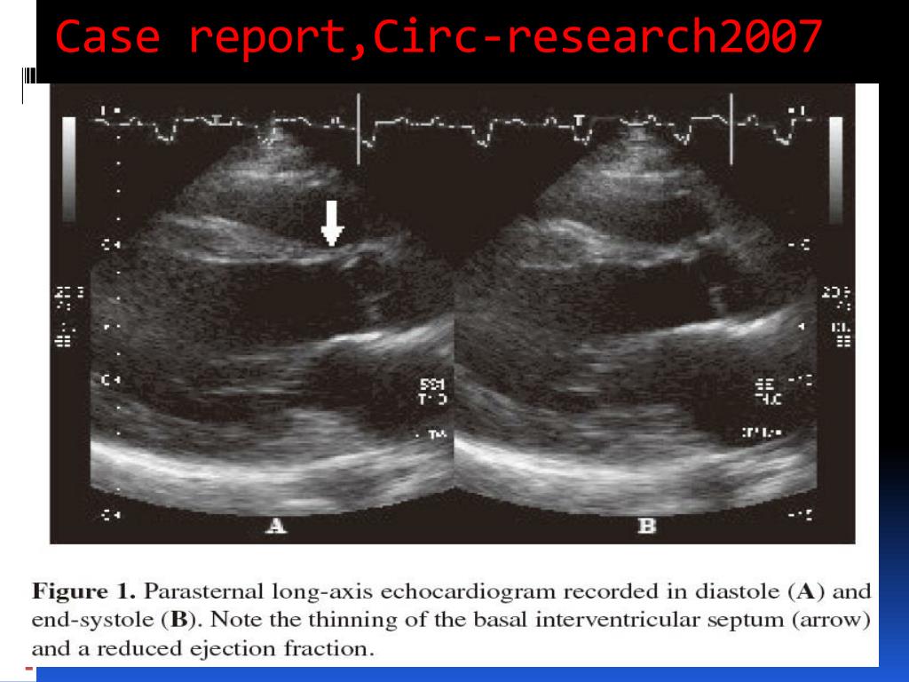PPT Echocardiography in sarcoidosis PowerPoint