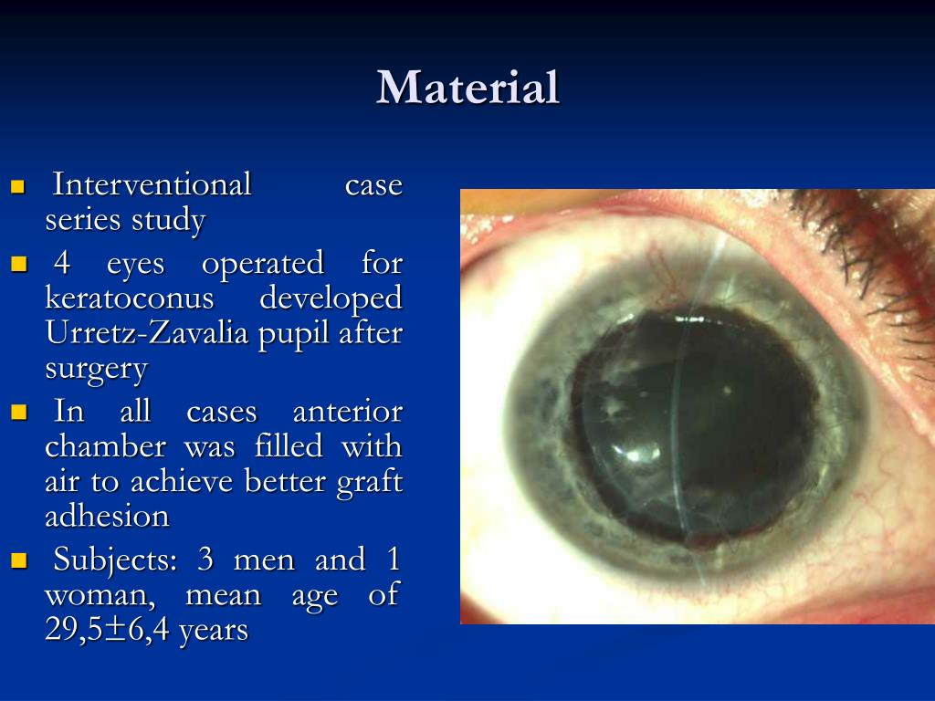 PPT Surgical approach of UrretzZavalia syndrome and cataract after