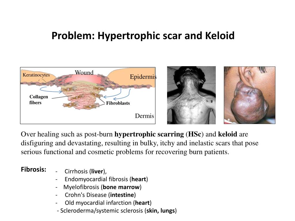 PPT Identifying Keratinocyte Derived Collagen Inhibitory Factors to