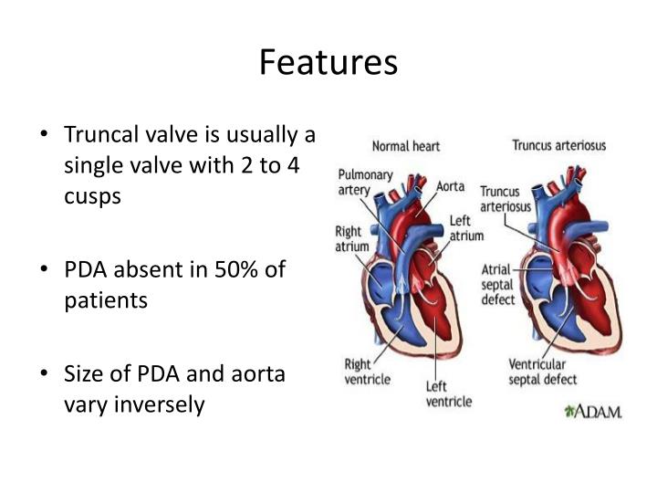 PPT Truncus Arteriosus PowerPoint Presentation ID6569500