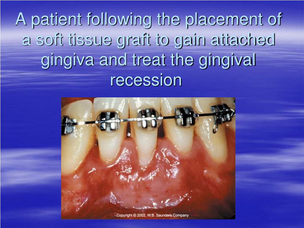 PPT EPIDEMIOLOGY OF PERIODONTAL DISEASE PowerPoint Presentation, free