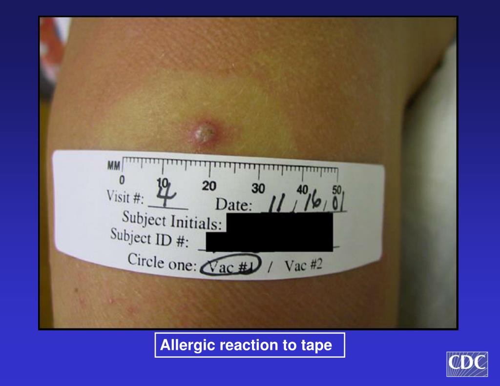 PPT Recognition of Adverse Reactions following Smallpox Vaccination
