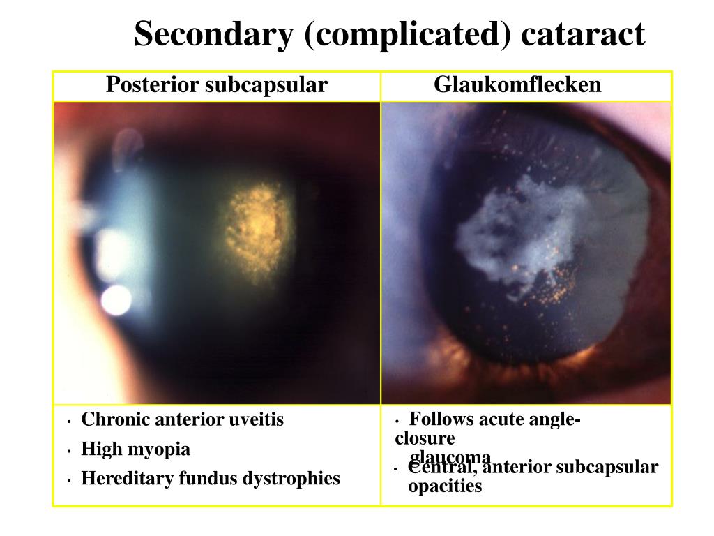 PPT OPHTHALMOLOGY CATARACTS PowerPoint Presentation, free download